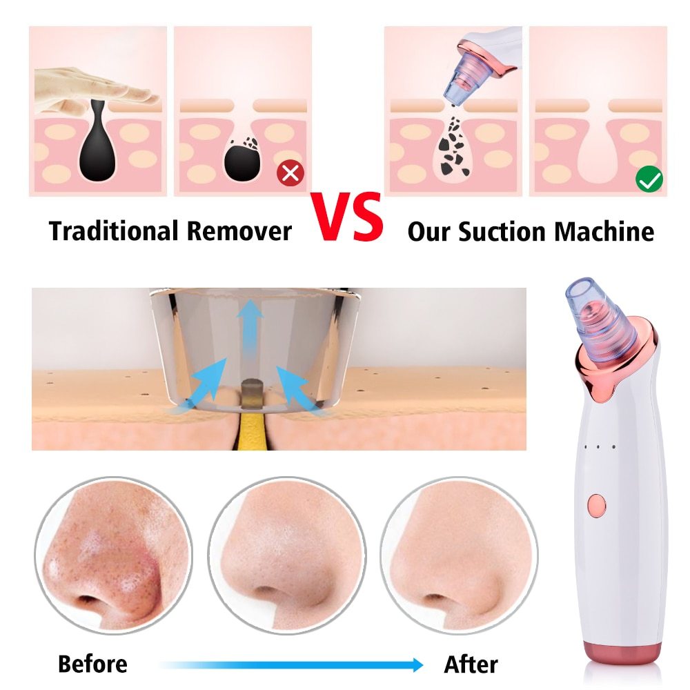 Electric Blackhead Remover – Facial Pore Cleaner & Acne Suction Tool
